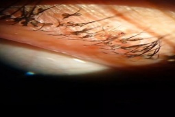 Ngứa mắt 3 tháng không khỏi, người phụ nữ đi khám phát hiện rận mu trên mí mắt