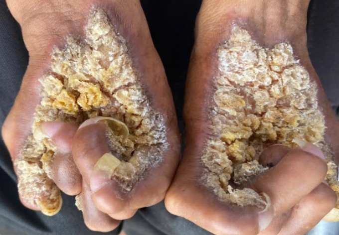 Bàn tay anh Sơn trước khi điều trị. Ảnh: Bác sĩ cung cấp