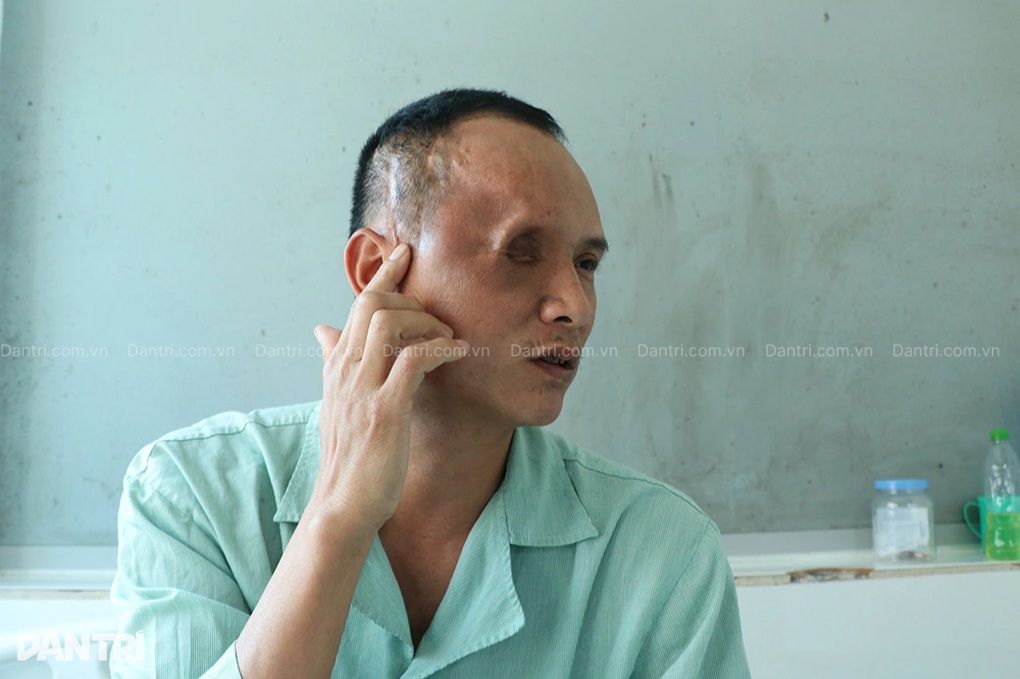 Người đàn ông mắc ung thư hiếm phải khoét một mắt, gồng gánh nuôi 3 con nhỏ - 1