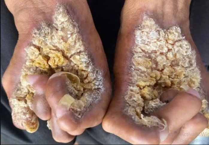 Ông S. phát bệnh từ lúc 2 tuổi.