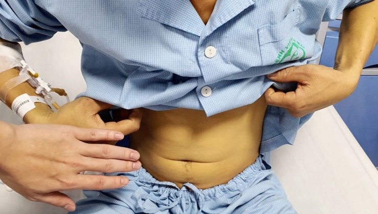 Bệnh nhân bị vàng da do suy gan vì uống mật cá trắm. Ảnh: BVCC.