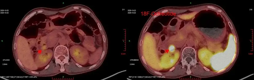 Người phụ nữ suy sụp vì tiêu chảy kéo dài suốt 3 năm, nguyên nhân không ai ngờ tới 1 Hình ảnh siêu âm.