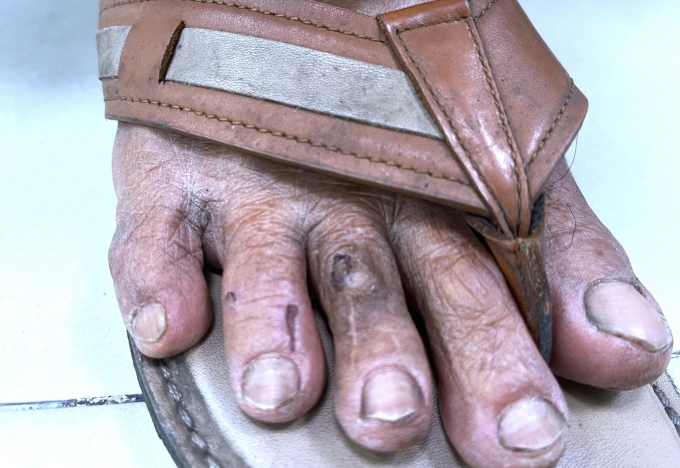 Vết thương do chó hàng xóm cắn chảy máu vào ngày 8/12 ở hai ngón chân phải ông Hùng. Ảnh: Diệu Thuần