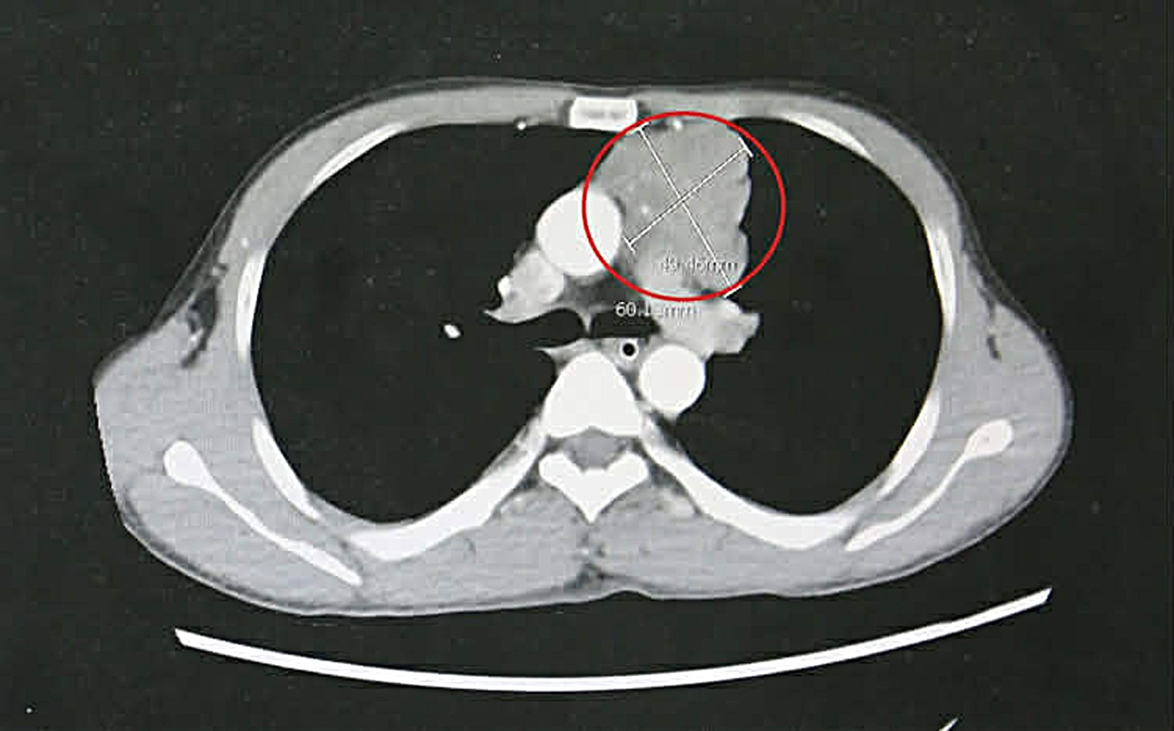 Nhiều người trẻ khỏe bỗng khó thở, liệt cơ, bác sĩ cảnh báo bệnh tự miễn nguy hiểm 2 nhược cơ - Ảnh 3.