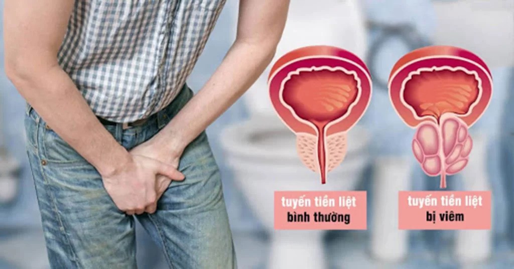 Những thói quen gây hại cho tuyến tiền liệt quý ông cần tránh 3 Những thói quen gây hại cho tuyến tiền liệt quý ông cần tránh - 2