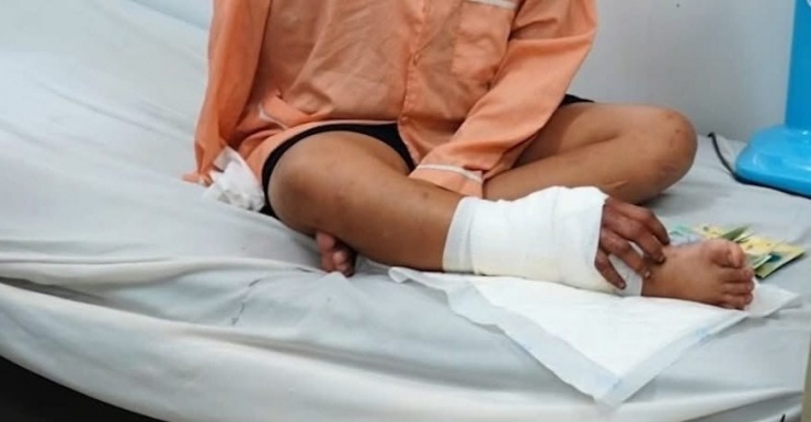 Cách đây 2 tháng, các bác sĩ đã ghép tạm thời bàn tay vào cẳng chân phải của bệnh nhân. Ảnh: ĐLBD.