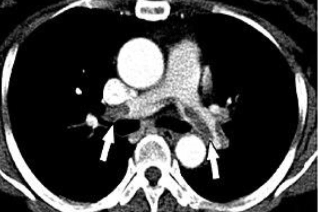 Nữ Việt kiều 60 tuổi tử vong vì biến chứng nặng sau khi hút mỡ, nâng ngực - 2