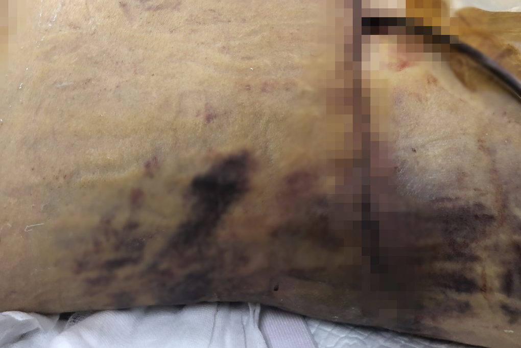 Nữ Việt kiều 60 tuổi tử vong vì biến chứng nặng sau khi hút mỡ, nâng ngực - 1