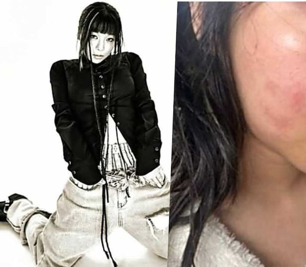 Nữ ca sĩ đau đớn tố bạn trai giam giữ, bạo hành nhưng không thể chia tay - 1