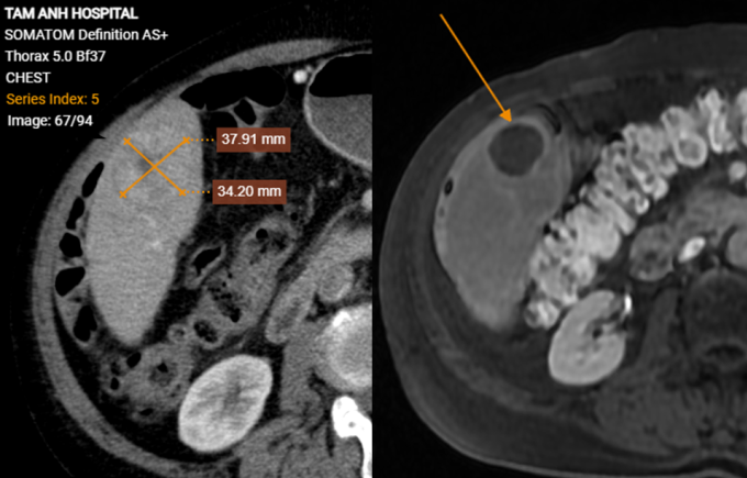 Khối u gan của bệnh nhân Phong trước (bên trái) và sau điều trị đã hoại tử (bên phải). Ảnh: Bệnh viện Đa khoa Tâm Anh