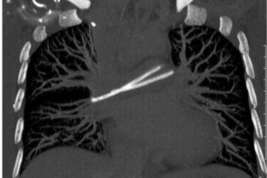 Ống thông truyền hóa chất bị đứt, trôi vào tim khiến người phụ nữ nguy kịch - 1