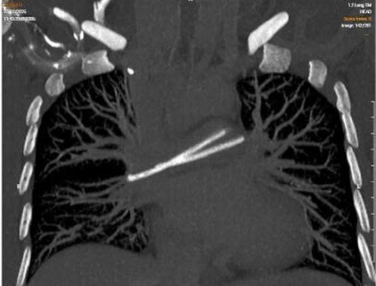 Ống truyền hóa chất trôi vào tim, bị bỏ quên nhiều năm trong cơ thể 1 Hình ảnh kiểm tra ghi nhận dị vật bị đứt trôi vào tim đe dọa trực tiếp tính mạng người bệnh