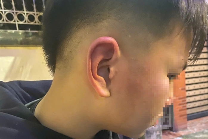 Phân định pháp lý vụ bé trai 12 tuổi bị bố bạn tát, đánh vào đầu 1 img