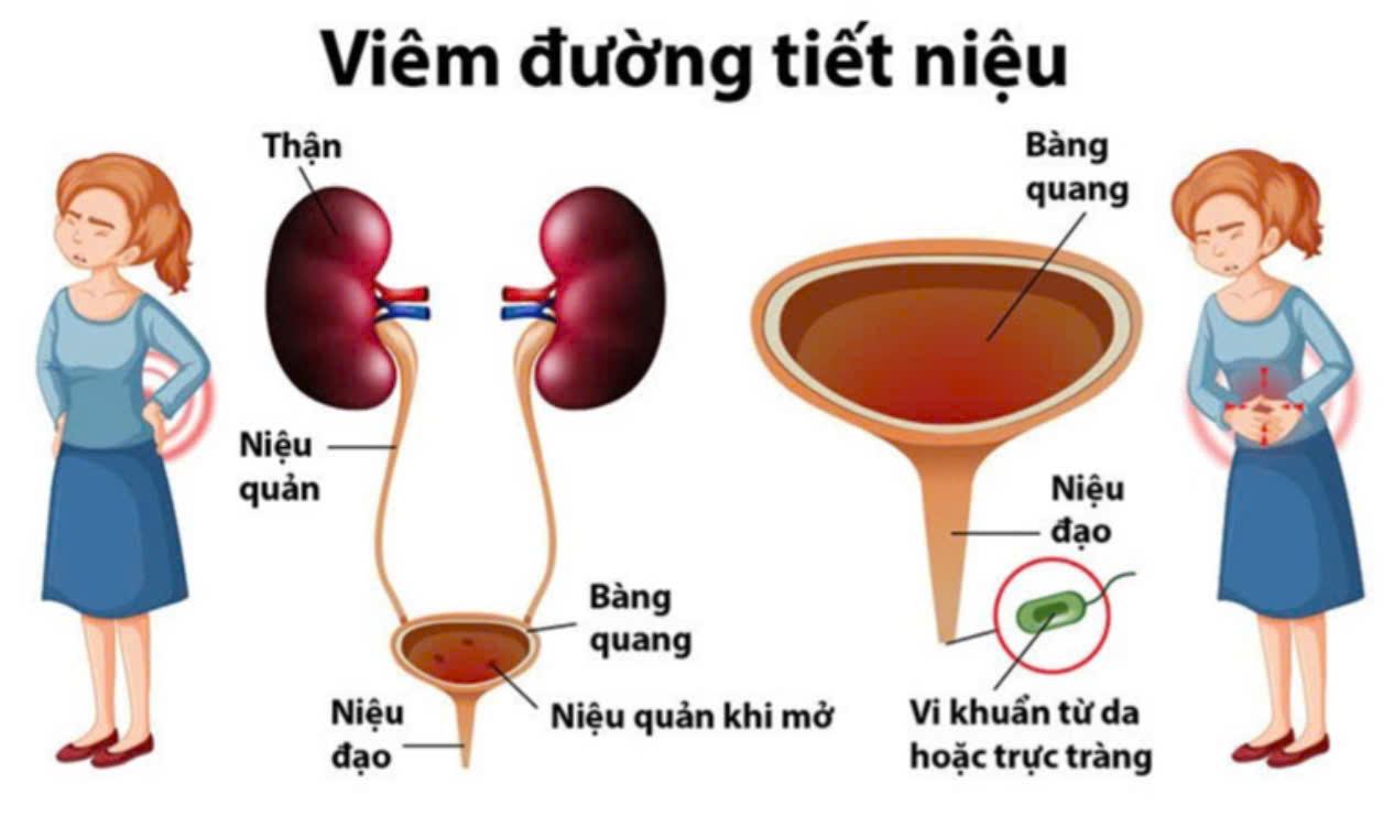 Phụ tiền mãn kinh dễ mắc nhiễm trùng đường tiết niệu do đâu? - Ảnh 1. tiết niệu - Ảnh 1.