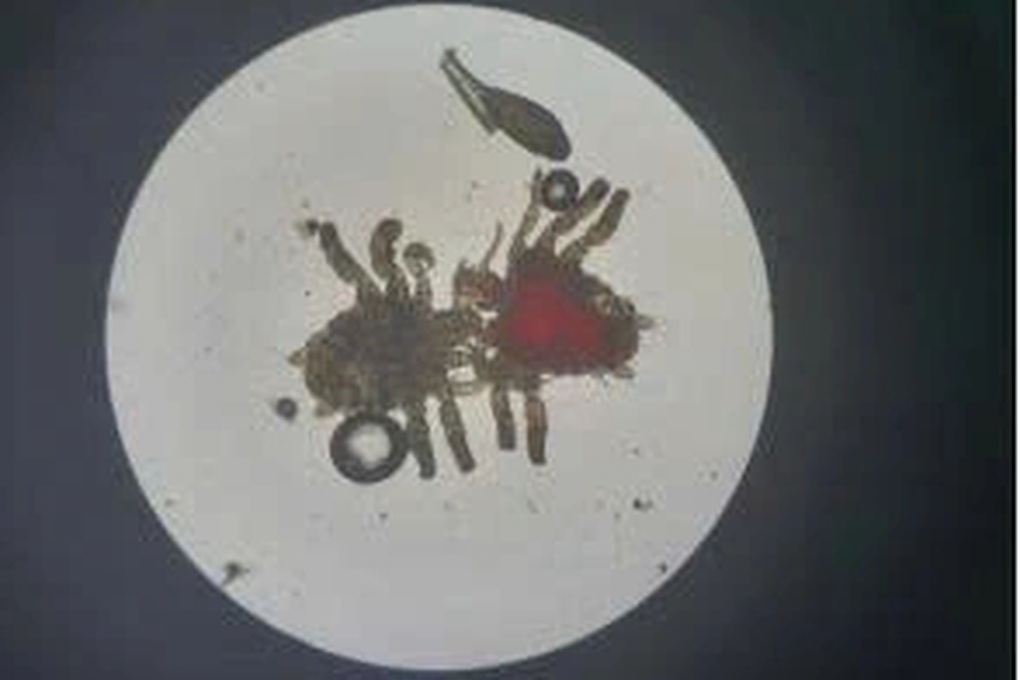 Quý ông tá hỏa phát hiện cả đàn rận sống nhờ ở vùng kín - 1