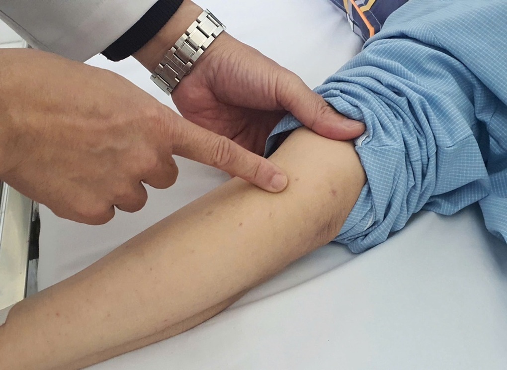 Số ca bệnh do não mô cầu tăng mạnh - 1