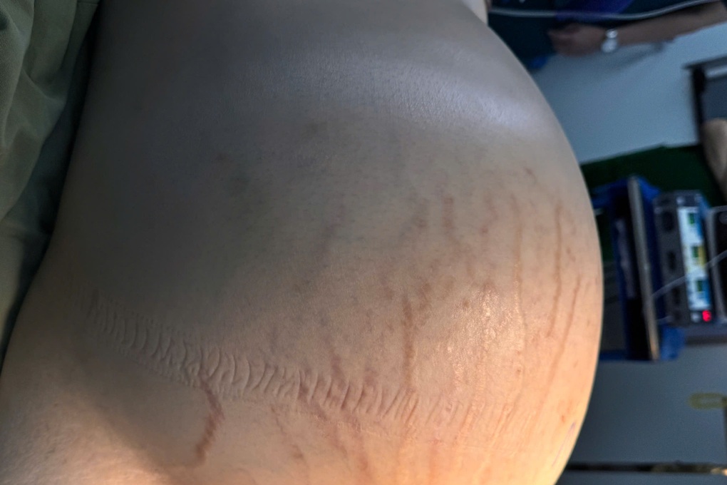 TPHCM: Cô gái che giấu bụng to vì sợ hiểu lầm, khối ung thư phát triển 15kg - 1