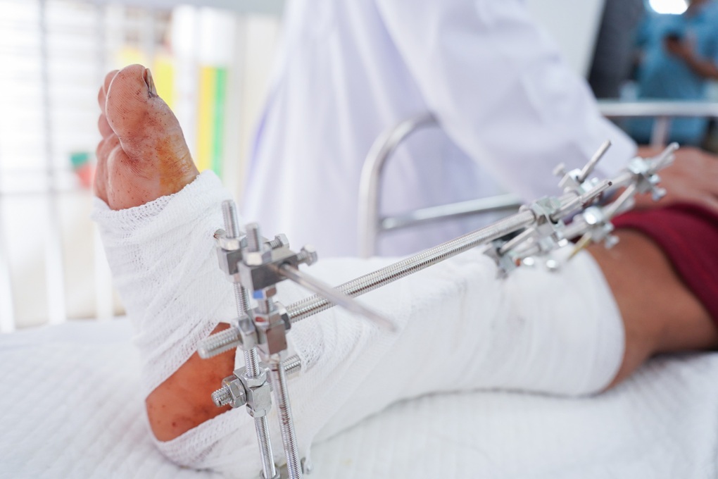 TPHCM: Nhiều người gặp tai nạn đứt lìa chi, bàn chân bị nghiền nát - 1