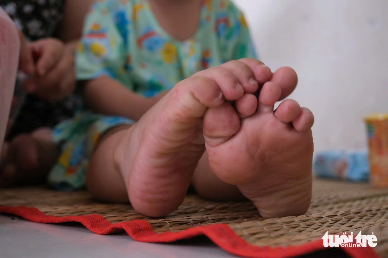 TP.HCM: Tác nhân EV71 tái xuất, ca mắc tay chân miệng nặng tăng - Ảnh 1.