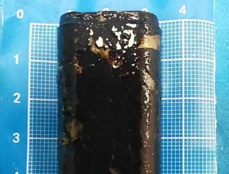 TQ: Người đàn ông sống với chiếc bật lửa trong bụng suốt 30 năm 1 Chiếc bật lửa được lấy ra sau 30 năm.