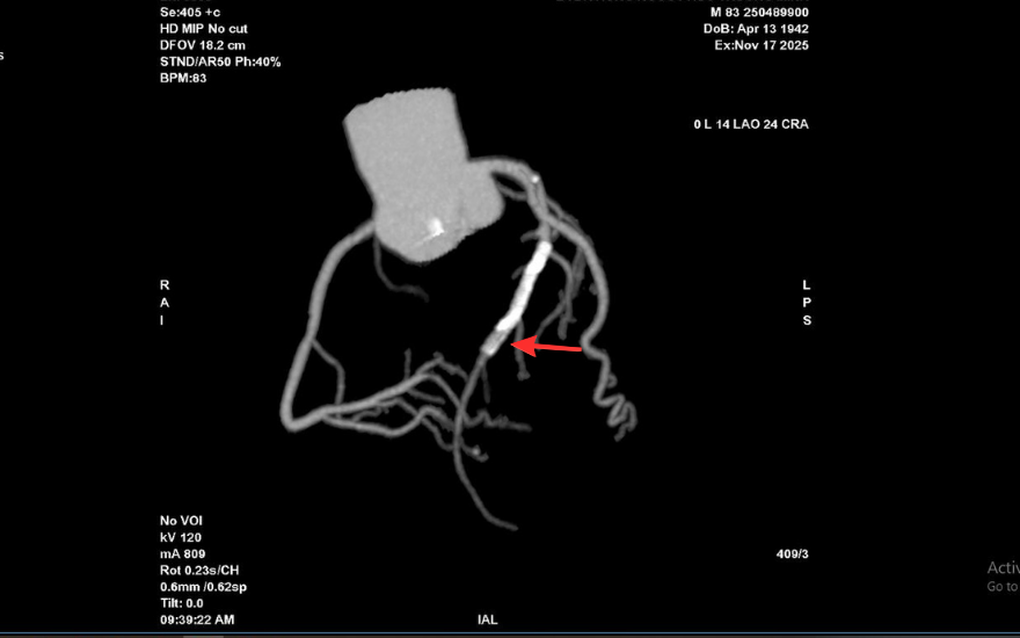 Tái hẹp 99% mạch vành sau đặt stent do ngưng uống thuốc điều trị - 1