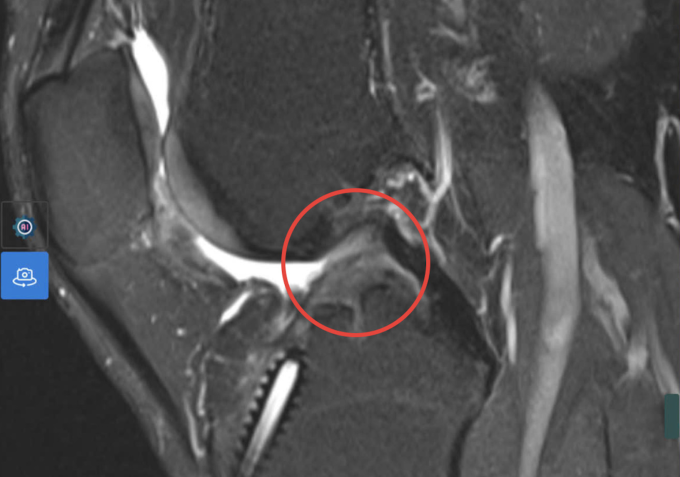 Kết quả chụp MRI cho thấy dây chằng chéo trước đã đứt hoàn toàn. Ảnh: Bệnh viện Đa khoa Tâm Anh