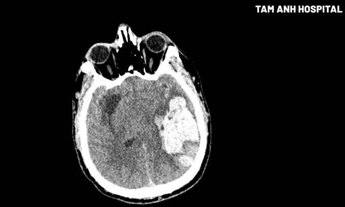Hình ảnh khối máu tụ ở thùy thái dương đỉnh trái của người bệnh qua phim chụp CT. Ảnh: Bệnh viện Đa khoa Tâm Anh Hà Nội