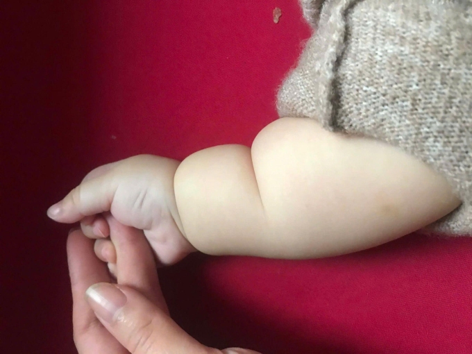 Ngấn tay ở trẻ có thể là dấu hiệu cảnh báo hội chứng vòng thắt chi bẩm sinh. Ảnh minh họa: Đình Lâm