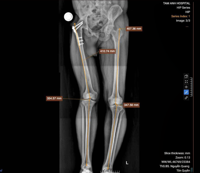 Khớp háng phải của anh Giang bị đóng cứng khiến chân, khung chậu và cột sống biến dạng sau 32 năm. Ảnh: Bệnh viện Đa khoa Tâm Anh