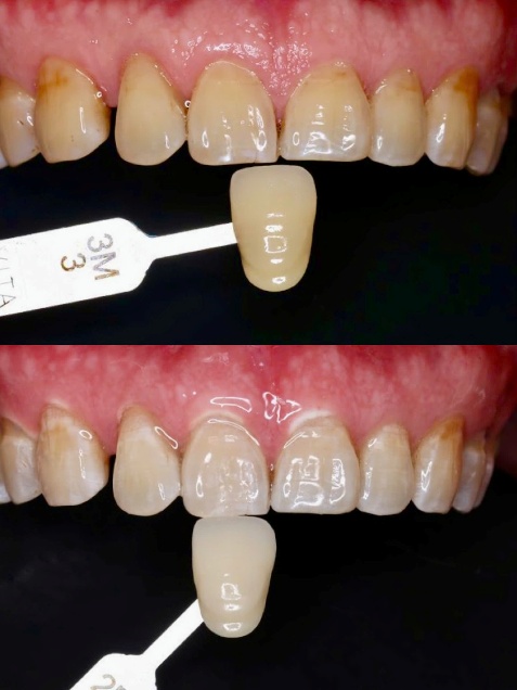 Thực hư chuyện tẩy trắng răng gây ê buốt? - Ảnh 1.