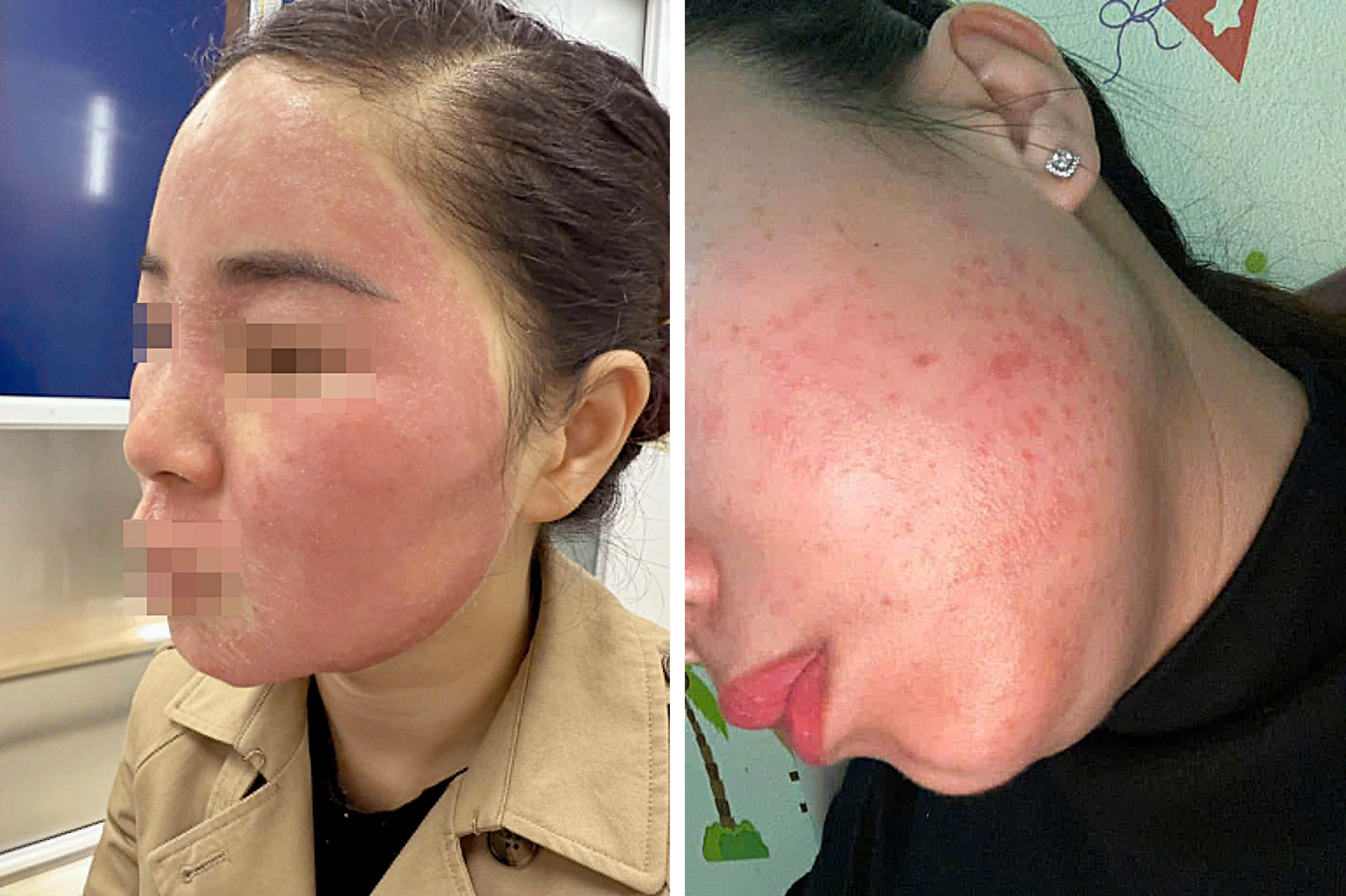 tretinoin - Ảnh 2.