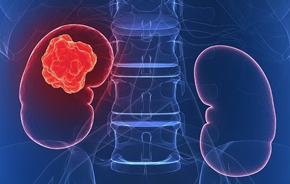 Từ vụ bé 8 tuổi qua đời vì ung thư thận: 5 thói quen ăn uống tàn phá thận, người Việt nhất định phải tránh 1 Ảnh minh họa.