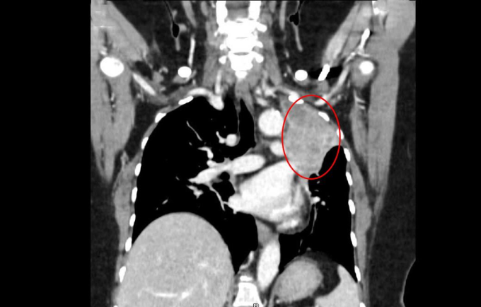 Kết quả chụp CT thấy phổi trái bà Hoa có khối u hơn 7cm. Ảnh: Bệnh viện Đa khoa Tâm Anh