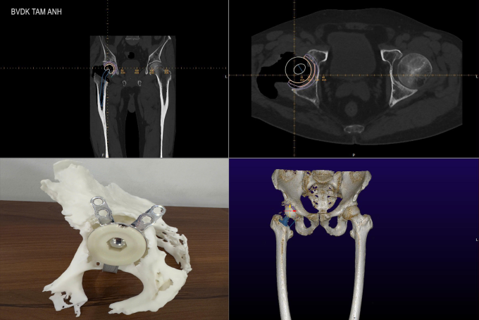 Các công nghệ 3D được sử dụng trong ca mổ của ông Frederik: chụp CT 3D, tính toán trên MediCAD 3D và mô hình khớp háng tỷ lệ 1:1. Ảnh: Bệnh viện Đa khoa Tâm Anh