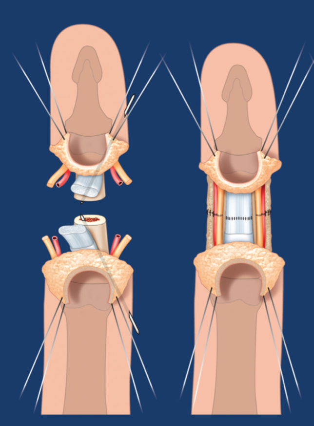 Vi phẫu thuật thành công nối ngón tay bị đứt rời sau 25 giờ - Ảnh 2. Vi phẫu thuật nối thành công ngón tay của thủy thủ tàu viễn dương bị đứt rời sau 25 giờ - Ảnh 2.