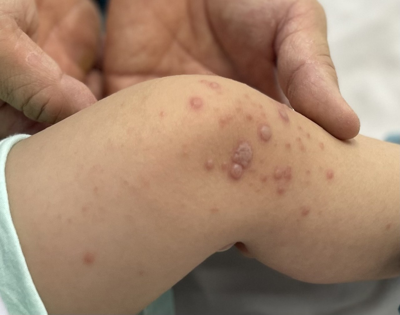 Vi rút EV71 độc lực mạnh nhất gây bệnh tay chân miệng nặng, cần đề phòng gì?- Ảnh 2. Vi rút EV71 độc lực mạnh nhất gây bệnh tay chân miệng nặng, cần đề phòng gì?- Ảnh 2.