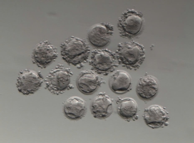 Toàn bộ trứng của chị Liên có hình thái móp méo, bất thường. Ảnh: BVĐK Tâm Anh