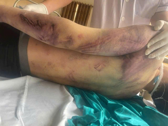 Cơ thể cháu Nam khi được đưa từ trung tâm vào viện. Ảnh GĐCC