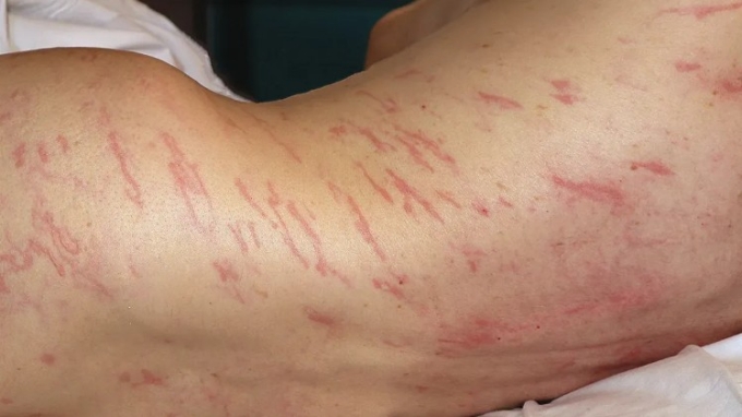 Các bác sĩ phát hiện vết phát ban đỏ trên cơ thể người đàn ông ở Tây Ban Nha có dấu hiệu di cư khắp làn da của ông ta. Ảnh: The New England Journal of Medicine