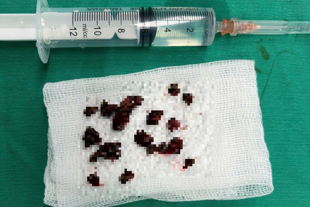 Người đàn ông Phú Thọ nhiễm loại nấm đen nguy hiểm ăn mòn xương - 2