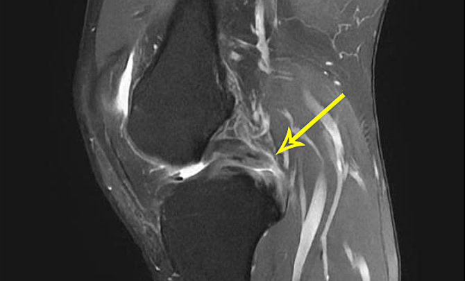 Phim MRI cho thấy dây chằng chéo sau của anh Giang đứt hoàn toàn. Ảnh: Bệnh viện Đa khoa Tâm Anh