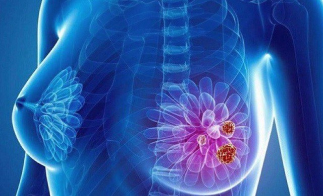 5 vị trí tế bào ung thư dễ đột nhập, người Việt nên hiểu đúng để ngừa bệnh từ sớm 4 Ảnh minh họa.