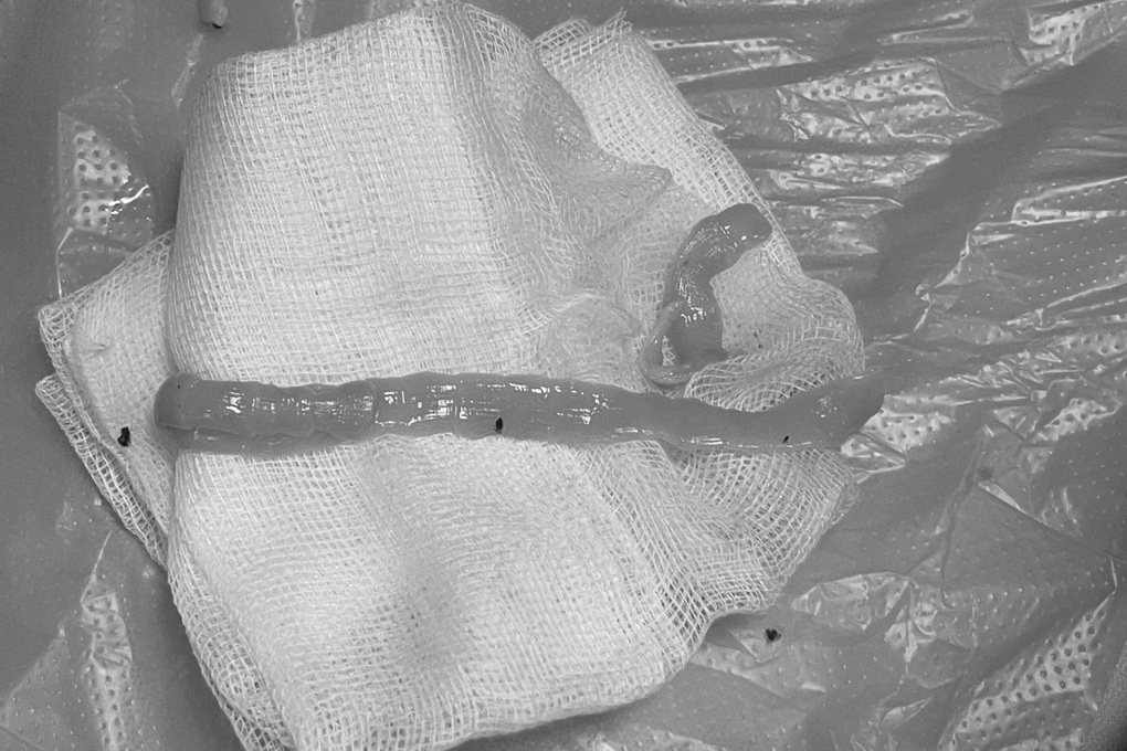 Sán dài 1m ngọ nguậy trong ruột người đàn ông thích ăn bò tái - 2