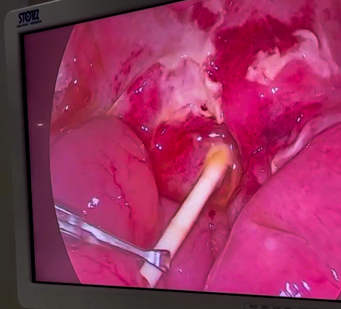 Cứu sống hai em bé nuốt kim băng và cây kẹo mút 2 bệnh nhi - Ảnh 2.