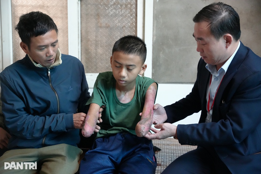 Trao hơn 142 triệu đồng tới nam sinh 14 tuổi bị điện giật phải cắt 2 tay - 3