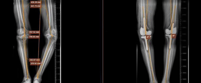 Phim chụp X-quang hai chân ông Tri trước (trái) và sau khi thay khớp. Ảnh: Bệnh viện Đa khoa Tâm Anh