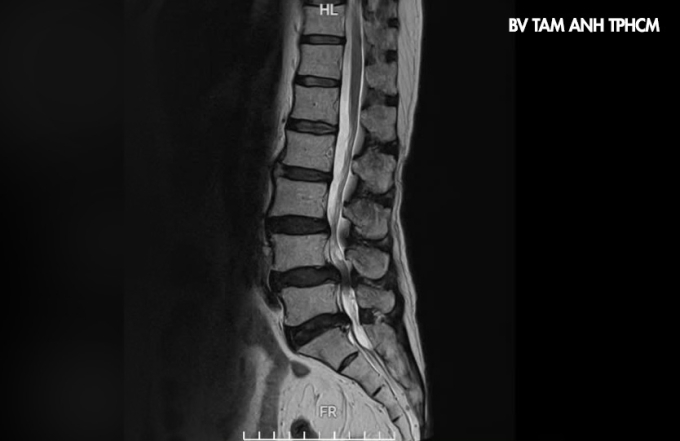 Ảnh chụp MRI của một người bệnh đau lưng do thoát vị đĩa đệm chèn ép ống sống, thần kinh. Ảnh: Bệnh viện Đa khoa Tâm Anh