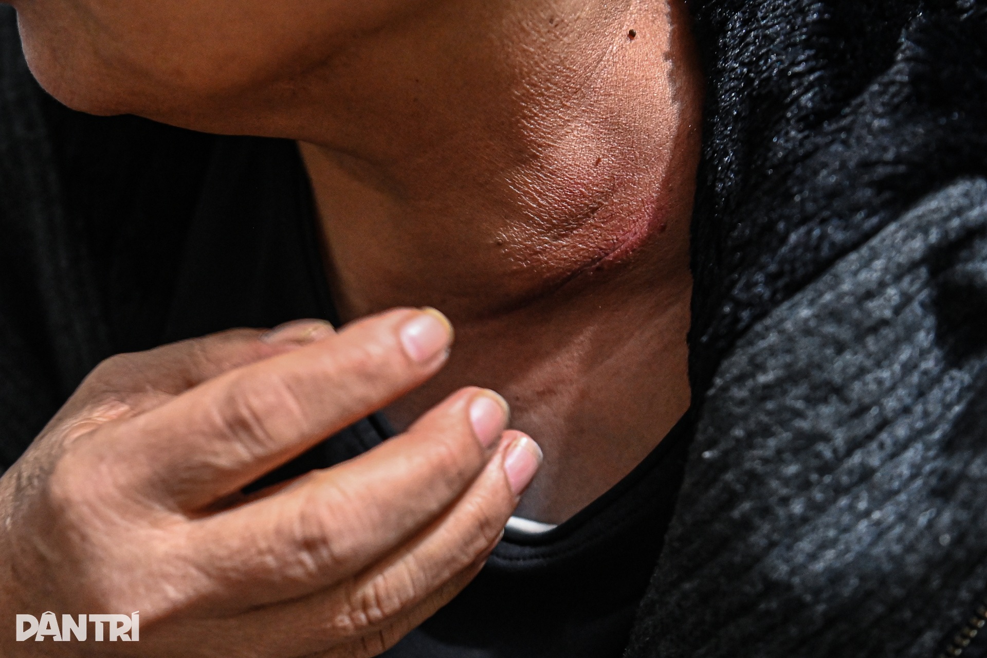 Những chuyến xạ trị lúc nửa đêm oằn mình trong giá rét của xóm ung thư - 10