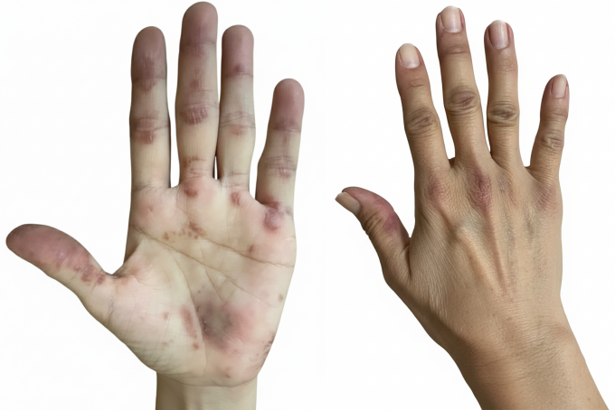 Hai bàn tay chị Mỹ bong tróc, nổi hồng ban, dày sừng trong hơn hai năm. Ảnh: Bệnh viện Đa khoa Tâm Anh