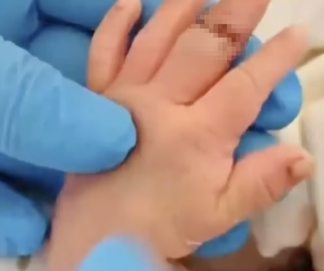 Cắt dây rốn, nữ hộ sinh vô tình cắt đứt ngón tay trẻ sơ sinh: Bé phải nối ngón, gia đình bàng hoàng- Ảnh 2.